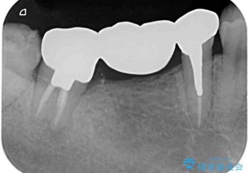 痛む奥歯 目立つ銀色の奥歯をセラミックに セラミックブリッジの治療前
