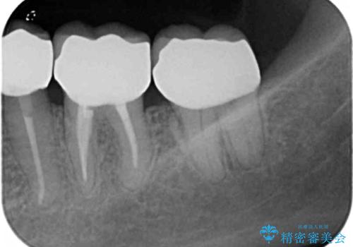 歯ぐきの腫れを改善する歯周外科手術を伴うセラミック治療の治療後