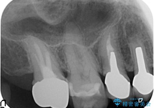 臼歯部メタルフリー再補綴の治療前