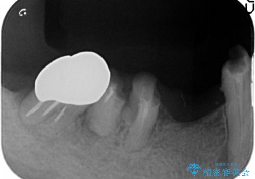 骨が薄く他院でインプラントできないと言われた 50代女性の治療前