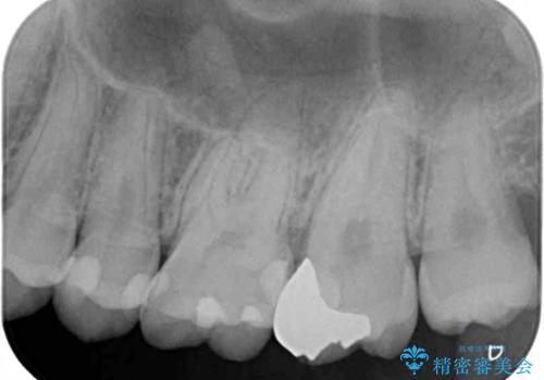 奥歯のむし歯をゴールドインレーで修復の治療後