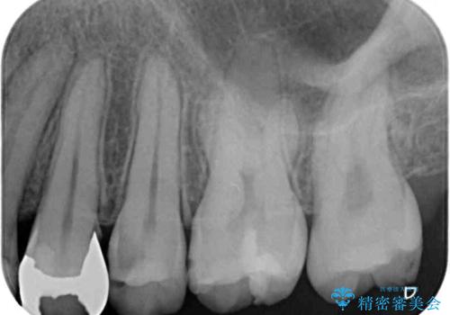 短期間での治療 急速拡大装置を併用したワイヤー装置による矯正治療の治療前