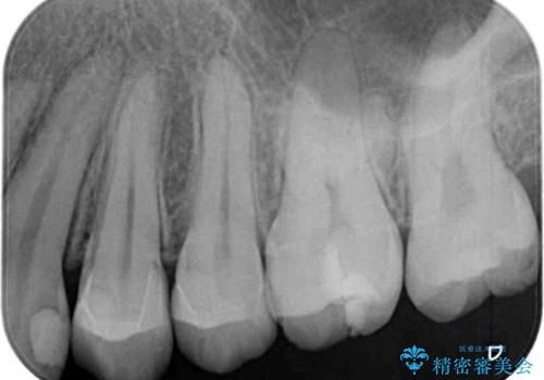 短期間での治療 急速拡大装置を併用したワイヤー装置による矯正治療の治療後
