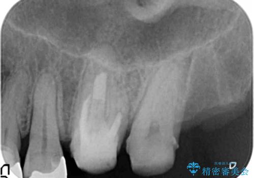 臼歯部インプラント・再補綴の治療中