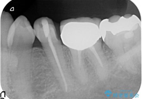歯ぐきの腫れを改善する歯周外科手術を伴うセラミック治療の治療前