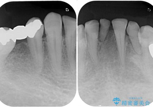 乳歯や矮小歯の多い前歯 部分矯正と補綴治療による審美歯科治療の治療前
