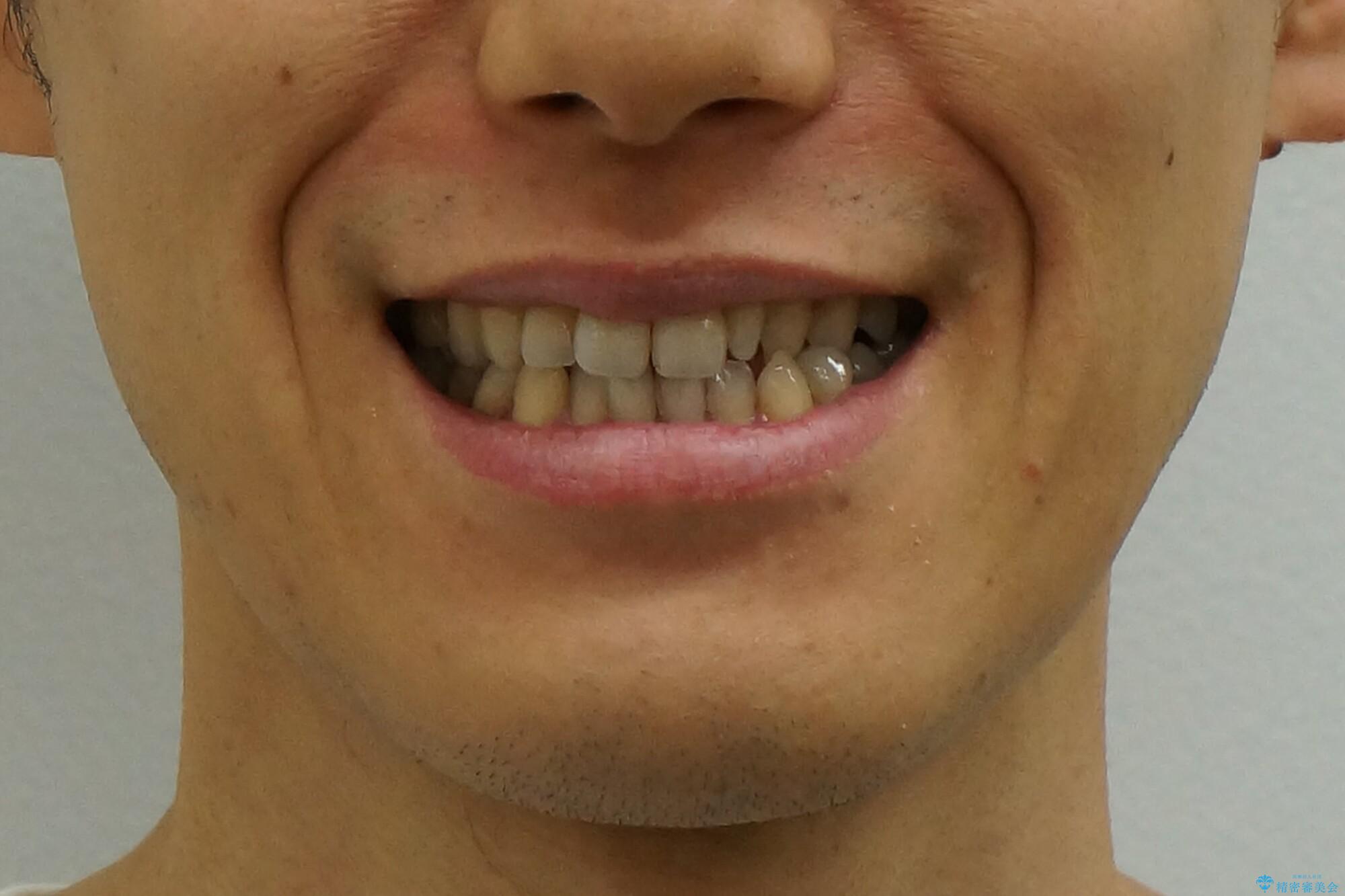 前歯の矮小歯 奥歯の反対咬合 をインビザラインでの治療前(顔貌)