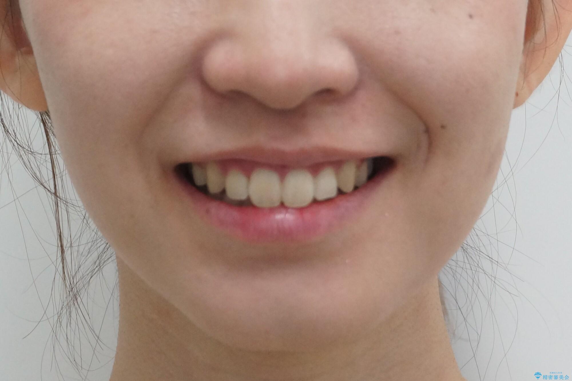 八重歯・前歯のがたつき　抜かない矯正　インビザラインでの治療後（顔貌）
