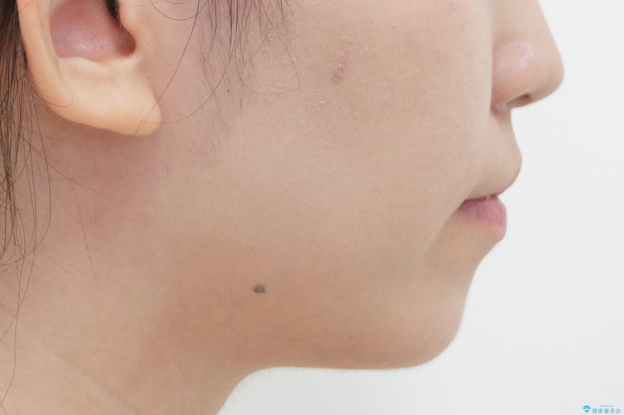 八重歯・前歯のがたつき 抜かない矯正 インビザラインでの治療後(顔貌)