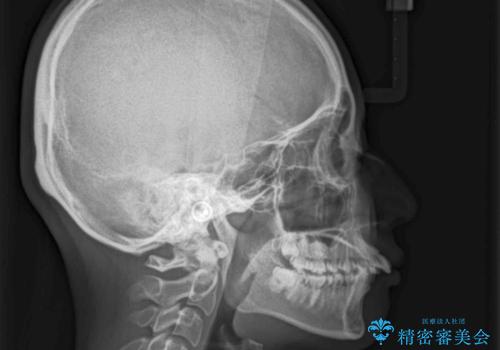 飛び出した前歯を引っ込めたい 目立たないワイヤーでの抜歯矯正の治療前