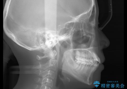 八重歯がスッキリ 抜歯ワイヤー矯正の治療前