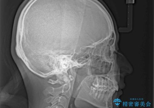 飛び出した前歯を引っ込めたい 目立たないワイヤーでの抜歯矯正の治療後