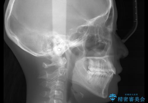 八重歯がスッキリ 抜歯ワイヤー矯正の治療後