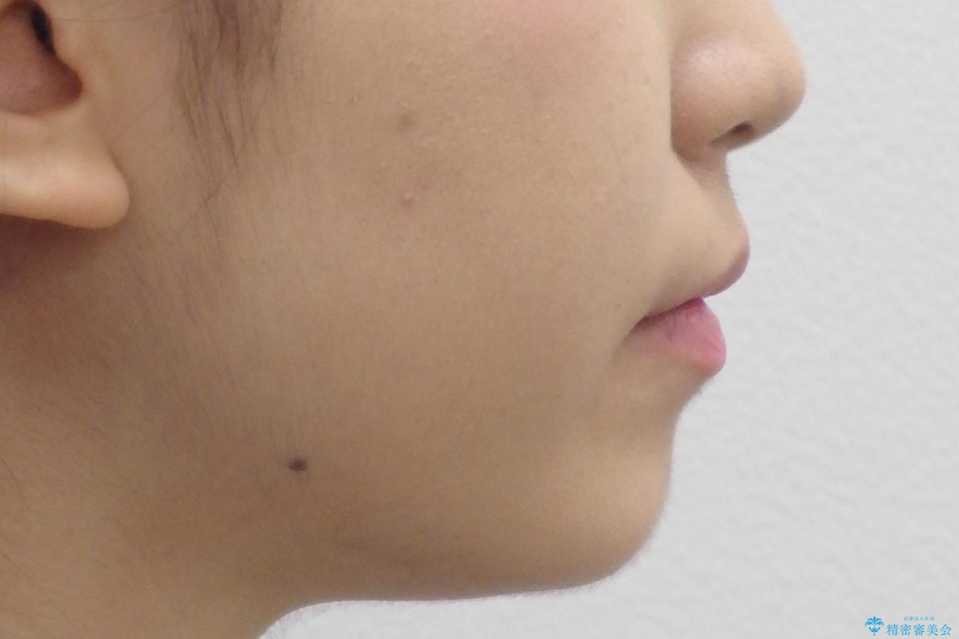 八重歯・前歯のがたつき 抜かない矯正 インビザラインでの治療前(顔貌)