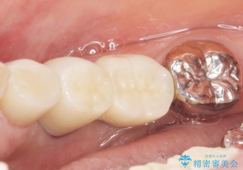 骨が薄く他院でインプラントできないと言われた 50代女性の治療後