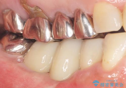 骨が薄く他院でインプラントできないと言われた 50代女性の治療後