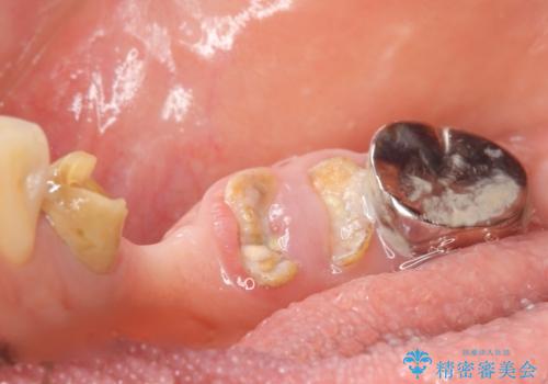 骨が薄く他院でインプラントできないと言われた 50代女性の治療前