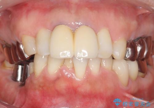 骨が薄く他院でインプラントできないと言われた 50代女性の治療中