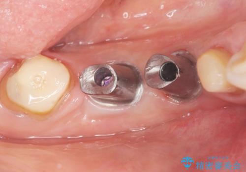 骨が薄く他院でインプラントできないと言われた 50代女性の治療後