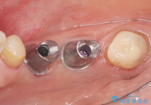 骨が薄く他院でインプラントできないと言われた 50代女性の治療後