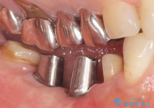 骨が薄く他院でインプラントできないと言われた 50代女性の治療後