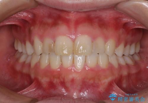 気になる前歯を治したい インビザラインで気づかれずに矯正治療の治療中