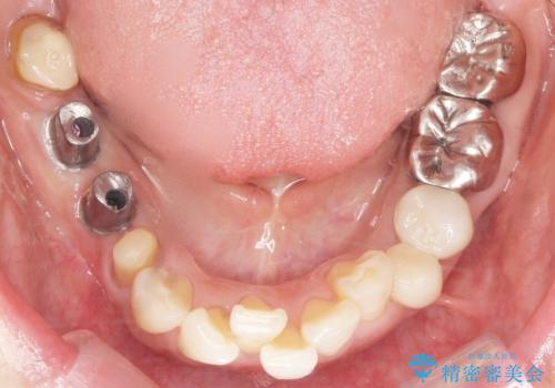 骨が薄く他院でインプラントできないと言われた 50代女性の治療中