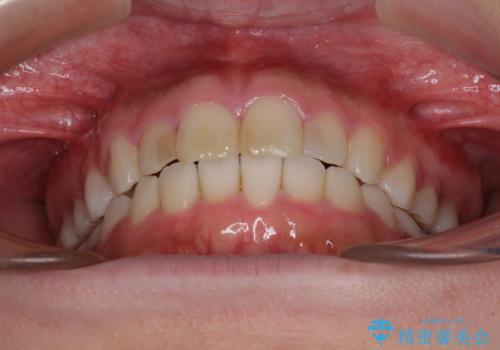 気になる前歯を治したい インビザラインで気づかれずに矯正治療の治療中