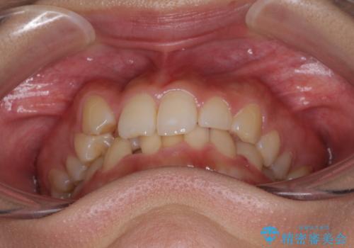 気になる八重歯を改善 補助装置併用のインビザライン治療の治療前