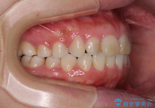 気になる前歯を治したい インビザラインで気づかれずに矯正治療の治療中