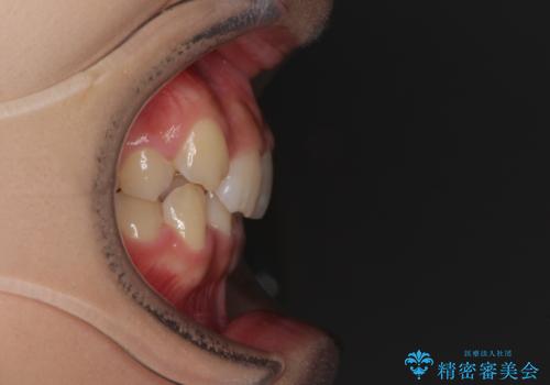 気になる八重歯を改善 補助装置併用のインビザライン治療の治療前