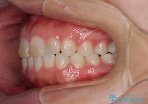 気になる前歯を治したい インビザラインで気づかれずに矯正治療の治療中