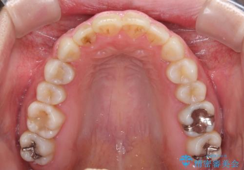 気になる前歯を治したい インビザラインで気づかれずに矯正治療の治療中