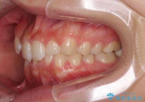 気になる八重歯を改善　補助装置併用のインビザライン治療の治療前