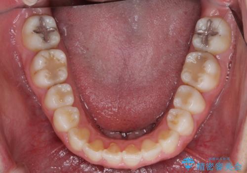 気になる前歯を治したい インビザラインで気づかれずに矯正治療の治療中