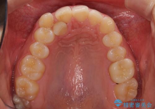 気になる八重歯を改善 補助装置併用のインビザライン治療の治療前