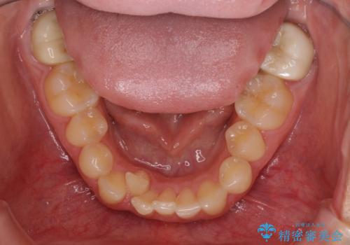 気になる八重歯を改善 補助装置併用のインビザライン治療の治療前