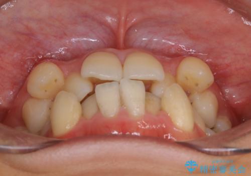 八重歯がスッキリ　抜歯ワイヤー矯正の治療前