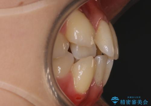 八重歯がスッキリ　抜歯ワイヤー矯正の治療前