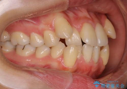八重歯がスッキリ 抜歯ワイヤー矯正の治療前