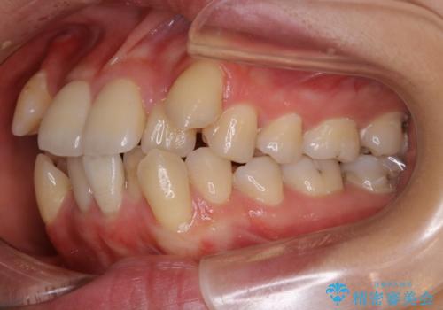 八重歯がスッキリ 抜歯ワイヤー矯正の治療前