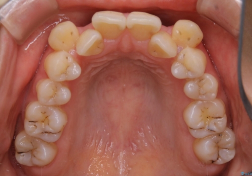 八重歯がスッキリ 抜歯ワイヤー矯正の治療前