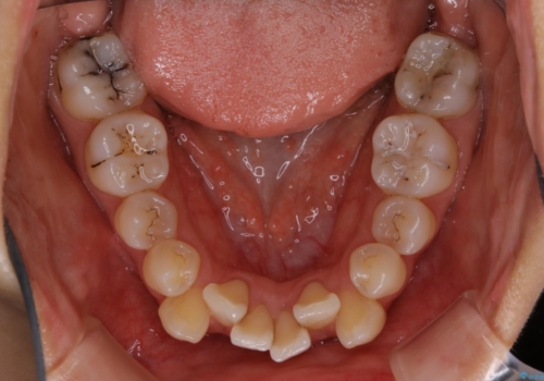 八重歯がスッキリ 抜歯ワイヤー矯正の治療前