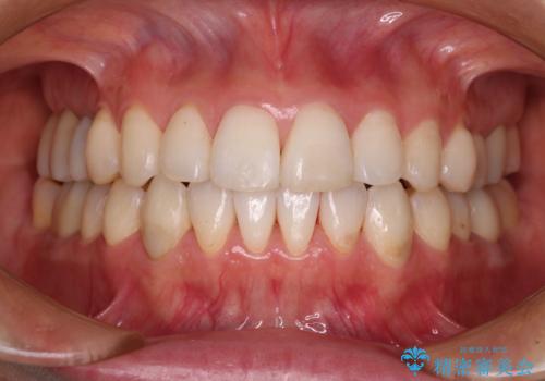 気になる前歯をインビザライン・ライトで　矯正治療後には銀歯をセラミックにの症例 治療後