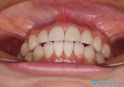 気になる前歯をインビザライン・ライトで 矯正治療後には銀歯をセラミックにの治療後