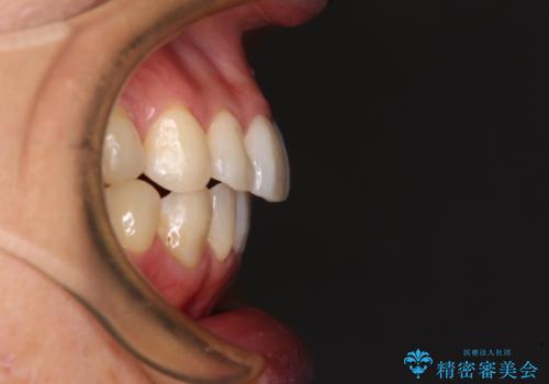 気になる前歯をインビザライン・ライトで 矯正治療後には銀歯をセラミックにの治療後