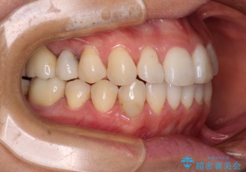 気になる前歯をインビザライン・ライトで 矯正治療後には銀歯をセラミックにの治療後