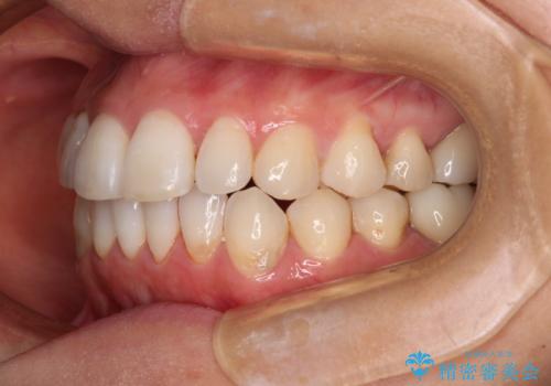 気になる前歯をインビザライン・ライトで 矯正治療後には銀歯をセラミックにの治療後