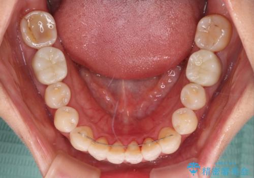 気になる前歯をインビザライン・ライトで 矯正治療後には銀歯をセラミックにの治療後
