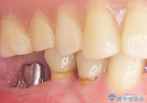 奥歯のインプラント　70代男性の治療後